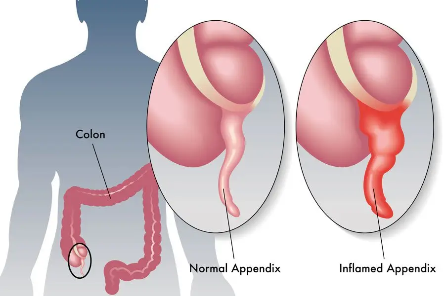 appendicitis