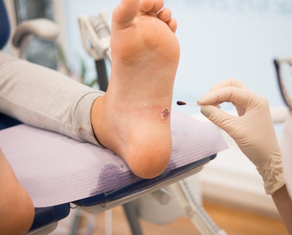 diabetic foot
