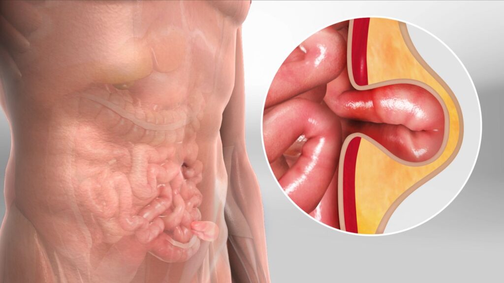 herniasurgerylaparo