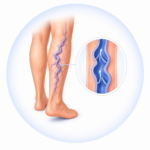 varicoseveins2