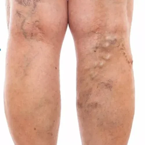 varicose veins why they occur and when treatment is needed 699be965caba1